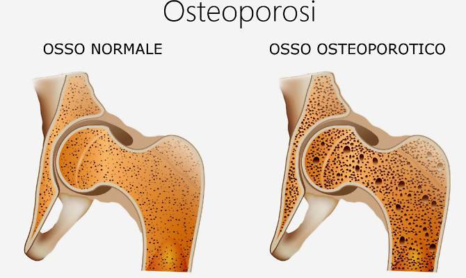 Incontro sulla salute:osteoporosi: Immagine